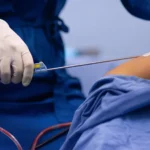 Panduan Lengkap Sedot Lemak: Prosedur, Risiko, dan Hasil yang Diharapkan